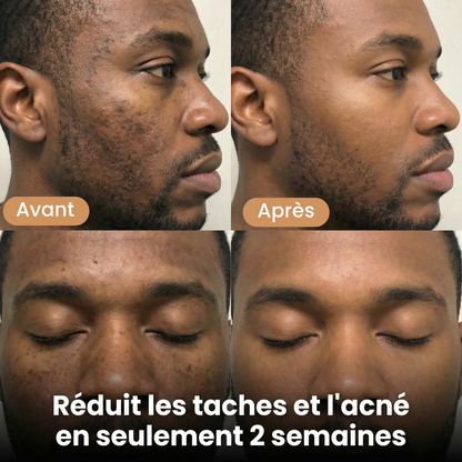 Savon Éclat au Curcuma — Réduit les taches et l'acné en seulement 2 semaines